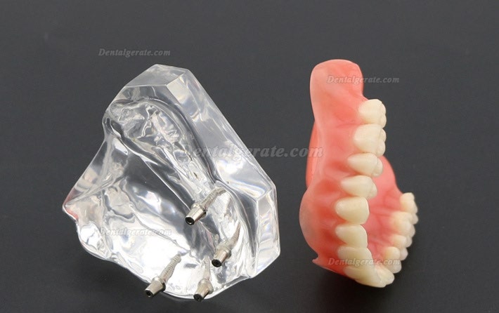 Anatomisches Modell der Zahnz&auml;hne &Uuml;berprothese Superior mit 4 Implantaten Demo Modell 6001
